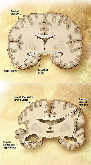comparison of two brains, normal above and with alzheimer's disease, below