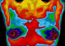 Thermography Breast Exam